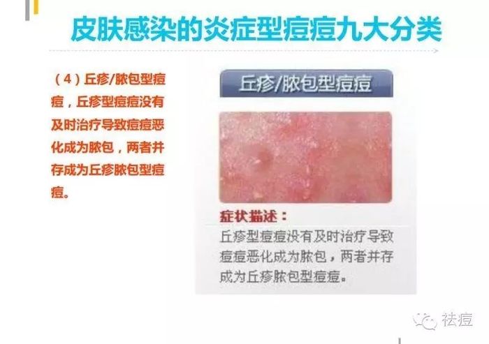 生物积聚造成炎性介质启动炎症;  4,毛囊角化引发皮脂腺毛孔淤堵 丘疹