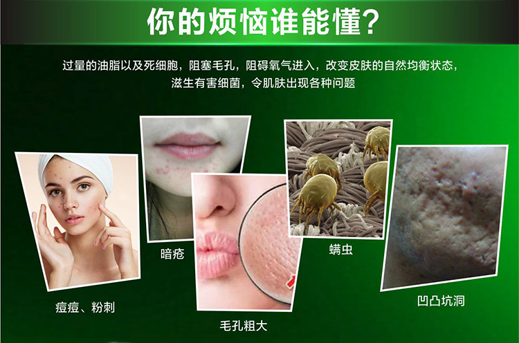 粉刺,暗疮,螨虫,凹凸坑洞 粉刺,暗疮,螨虫,凹凸坑洞