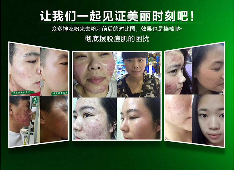 去粉刺案列 去粉刺案列