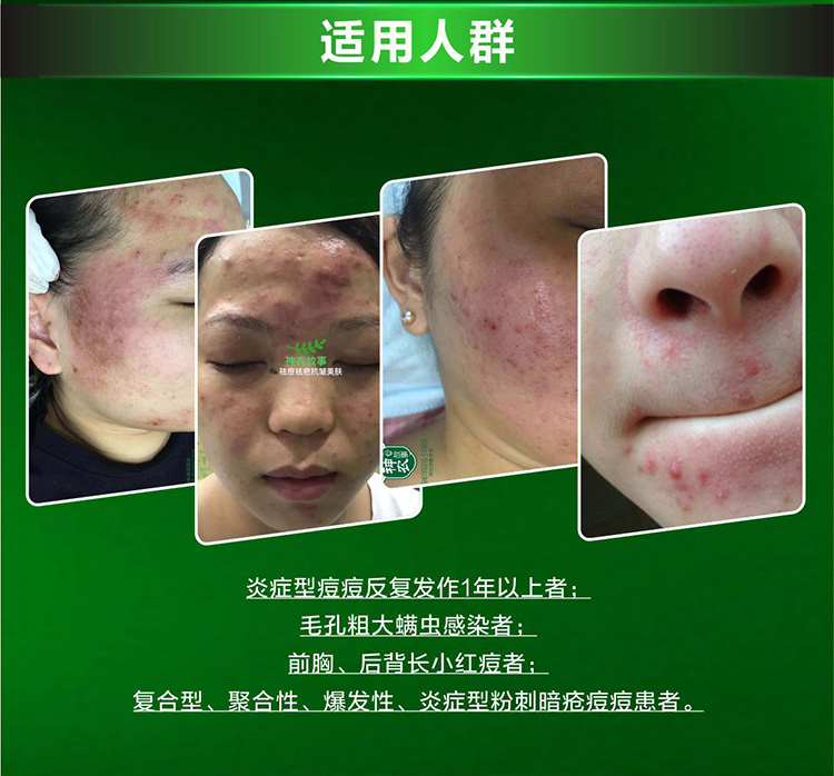炎症性痘痘,毛孔粗大 炎症性痘痘,毛孔粗大